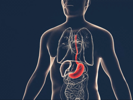 Symptoms of acid reflux or excess acid in the stomach.-80